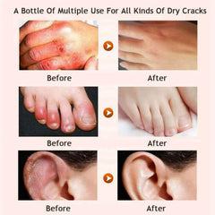 Before and after images showing effects of honey foot repair cream on dry, cracked skin and overall skin restoration.
