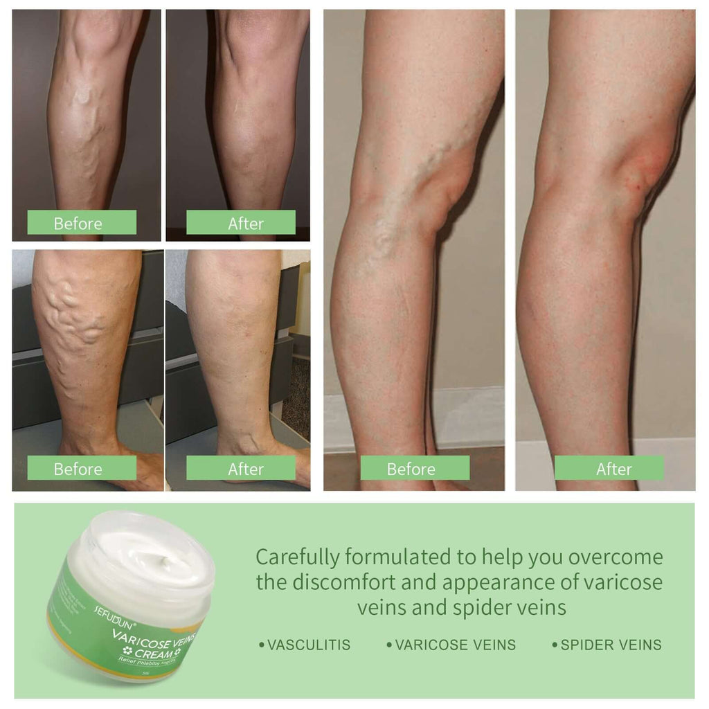 Before and after images showing the effects of varicose vein cream on legs with varicose and spider veins.