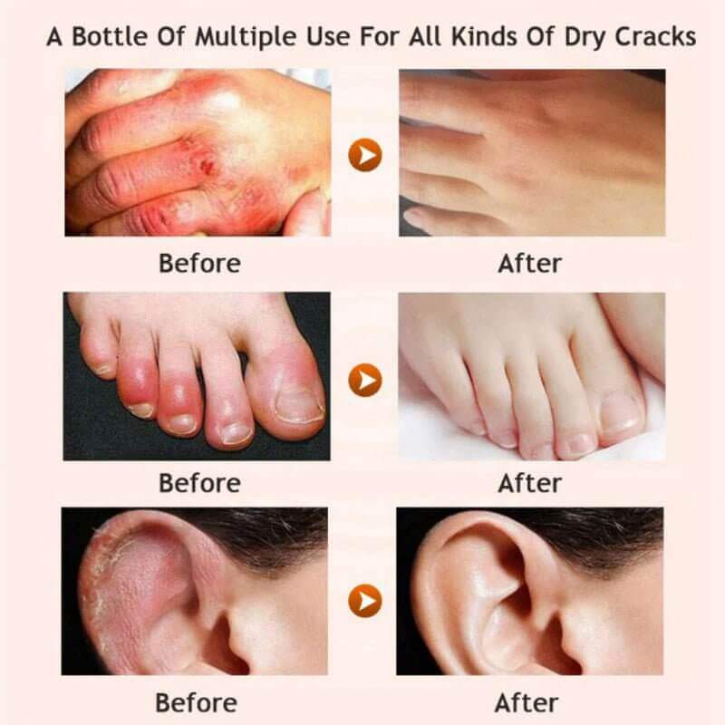 Before and after images showing effects of honey foot repair cream on dry, cracked skin and overall skin restoration.